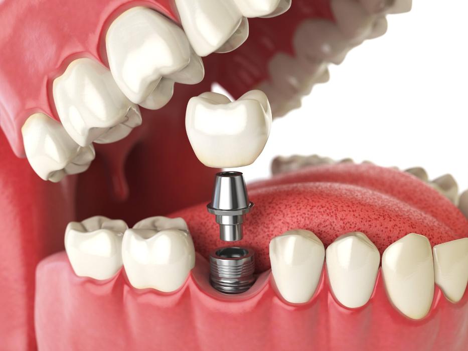 dental implants in grand rapids